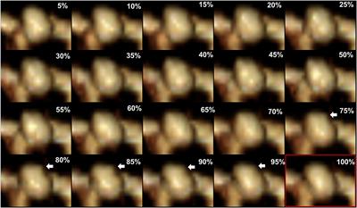 Irregular Pulsation of Intracranial Aneurysm Detected by Four-Dimensional CT Angiography and Associated With Small Aneurysm Rupture: A Single-Center Prospective Analysis